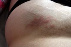 Blood disorder and bruising