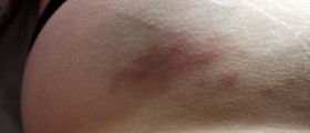 Blood disorder and bruising