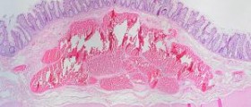 Blood mucus in stool