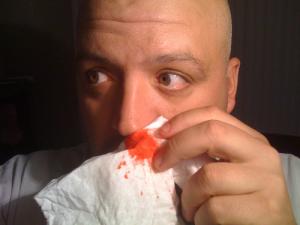 Bloody nose causes