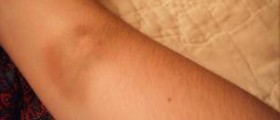 Bone bruise symptoms and treatment