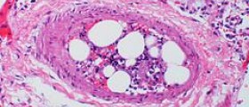 Bone marrow transplantation for Fanconi anemia