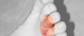 Bottom foot pain