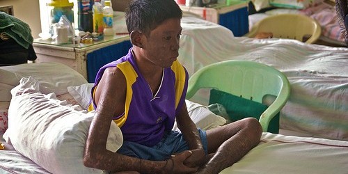 Leprosy - Unfinished Story