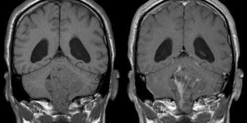 Marijuana and Brain Cancer: Are the Glowing Reports Really True?