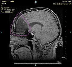 Brain aneurysm facts