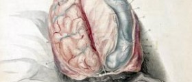 Brain aneurysms review