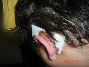 Brain tumors surgery