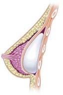 Breast benign nodule