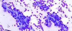 Breast dysplasia facts