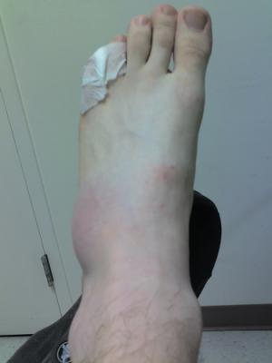 Broken pinky toe
