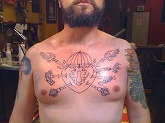 Broken rib treatment