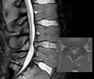 Bulging disc symptoms