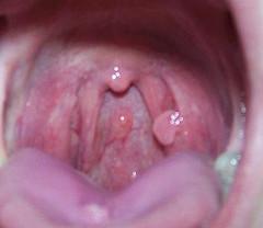 Small Bumps On Throat 48