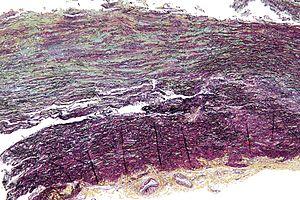 Caffeine cystic acne