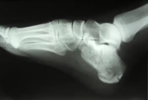 Calcaneal stress fractures