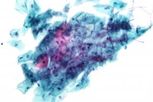 Candida cure that works