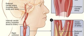 Carotid Artery Disease: Stenosis Symptoms and Treatments