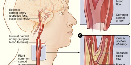 carotid-artery-blockage-test-general-center-steadyhealth