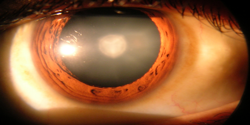 Cholesterol-Lowering Drugs Linked To Increased Risk Of Cataracts: Ten Things You Need To Know