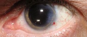 Cataract surgery cost in India