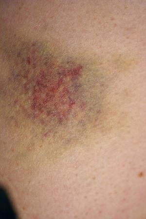 Causes of bruising