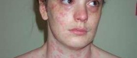 Causes of chronic hives