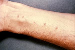 Causes of dermatitis
