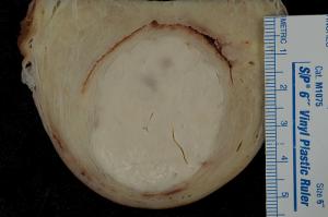 Causes of fibroids