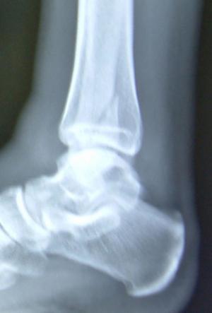 Causes of fractures