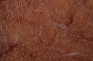 Causes of hyperthyroidism