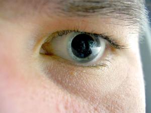 Causes of keratoconus