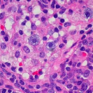 Causes of lymphoma