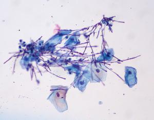 Causes of thrush