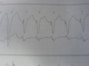 Causes of ventricular tachycardia