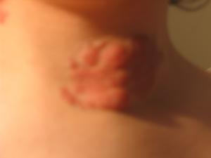 Causes, symptoms and treatmen for neurofibromatosis