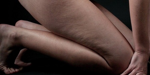 Laser Procedure Promises To Cure Cellulite In One Treatment