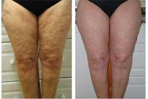 Cellulite: the biggest female epidemic