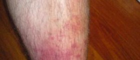 Cellulitis of the legs
