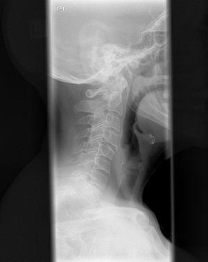Cervical kyphosis review