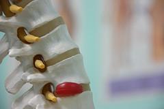 Cervical spine fusion for herniated disk in neck