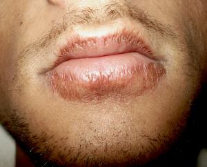 Chapped lips causes