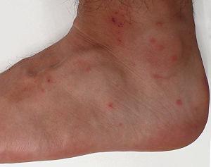 Chigger bite treatment
