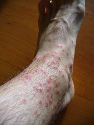 Chigger bites cure