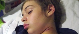 Study Discovered New Genes Causing Childhood Epilepsy