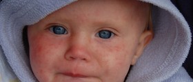 Once An Almost-Forgotten Disease, Measles Outbreak Strikes Children And Adults