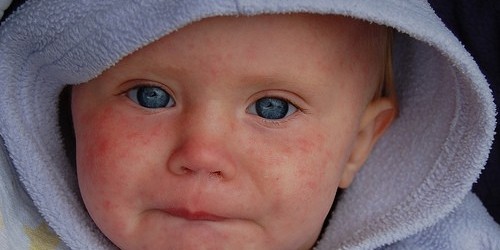 Once An Almost-Forgotten Disease, Measles Outbreak Strikes Children And Adults