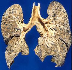 Children's guide for emphysema treatment
