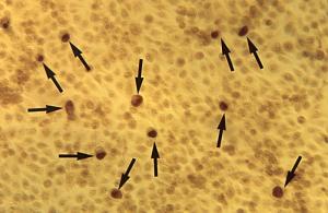 Chlamydia in men