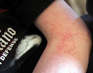 Chlorine rash facts